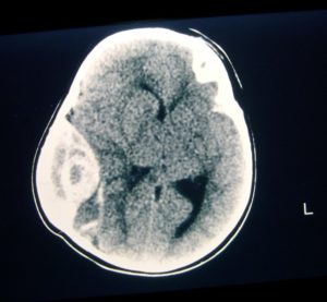 Head injury Epidural Hemorrhage