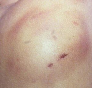 Bite Mark on body Forensic Pathologist Photo Export Witness