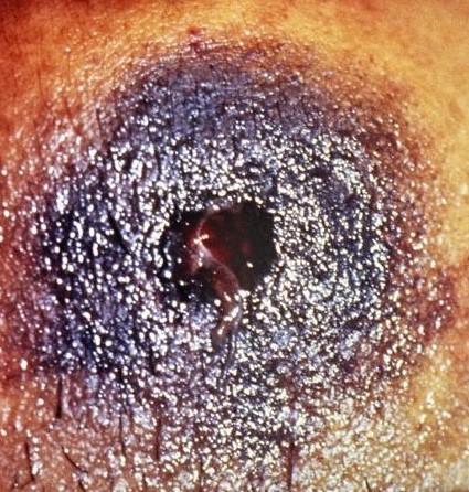 Bullet Wound Shot Close Range - Forensic Photo from Expert Forensic Pathologist